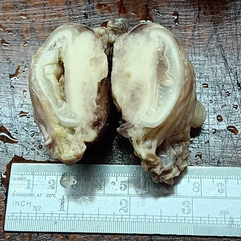Cystectomy specimen with a large polypoid tumor with an inward growth causing narrowing of the bladder cavity.