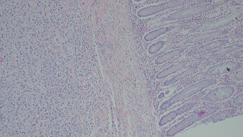Histopathology of the urinary bladder osteosarcoma metastasizing into the colon. Adjacent normal colon mucosa is seen near the tumor (H&E ×200).