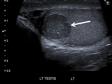 Ultrasound showing 14 × 12-mm hypoechoic mass in the upper pole of the left testis (see arrow).