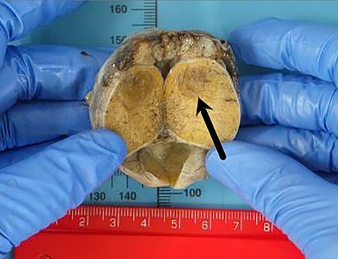 Macroscopic histology of the left testis demonstrating a 15 × 10-mm well-defined nodule in the upper pole (see arrow).