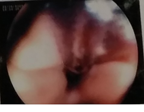 UGI endoscopy, clot with underlying ulceration in the esophagus.