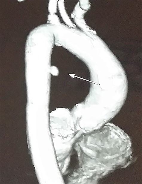 CE-CT image showing saccular aneurysm arising from the proximal descending thoracic aorta.