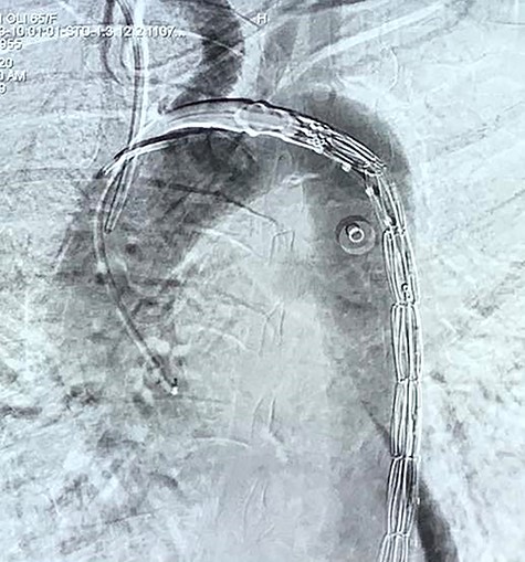Fluoroscopy image of endovascular stent before deploying.