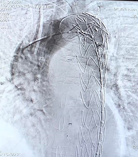 Endovascular stent after deployment.