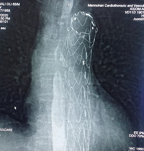 Gastrograffin swallow showing no esophageal leak.