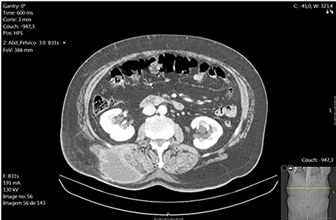 Right lumbar subcutaneous abscess (CT scan).
