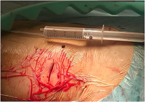 Retrieved gallstone from the right lumbar abscess cavity.