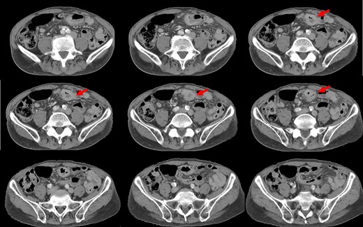 CT shows a tumor (arrows) in the sigmoid colon.