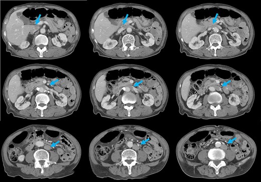 CT shows that, after connecting with the left renal veins, the left-sided IVC (arrows) crosses the abdominal aorta anteriorly to join a normal prehepatic segment of the IVC.