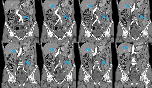 Coronal reformation of the CT image shows precisely how the left-sided IVC (arrows) ascended vertically along the left side of the abdominal aorta and crossed anterior to the aorta.