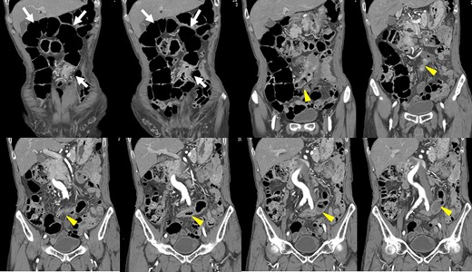 After coronal reformation, the CT images show that the descending colon was at the midline of the abdomen (arrowheads), and the sigmoid colon was in the right upper abdomen (arrows).