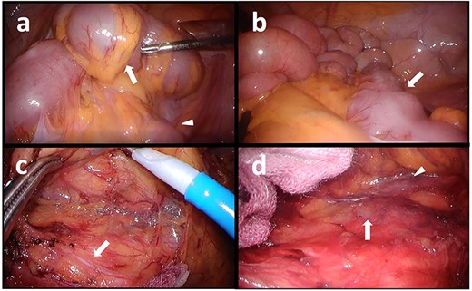 Intraoperative images: (a) Adhesion between the sigmoid colon (arrow) and the ileum (arrowhead), (b) The descending colon (arrow), (c) Dissection plane (hypogastric nerve is shown by the arrow), and (d) The left-sided IVC (arrow) and the left ureter (arrowhead).