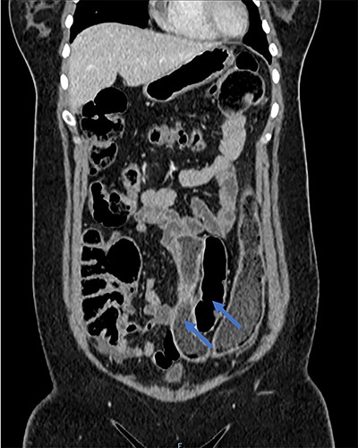 Coronal CT scan demonstrating native and duplicated tubular colon (indicated by blue arrows).