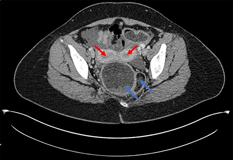 Axial CT scan demonstrating uterine didelphys (red arrows) and duplicated rectum (blue arrows).