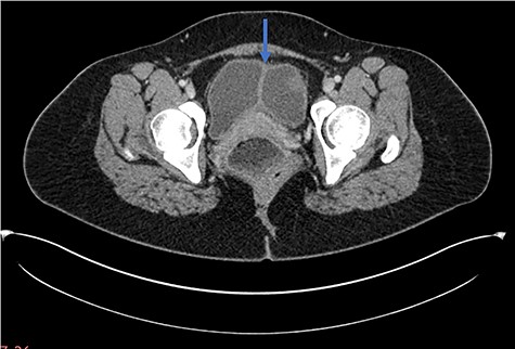 Axial CT scan demonstrating longitudinal sagittal septum giving rise to a duplicated bladder appearance.