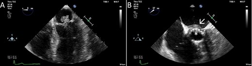 The TEE showed a large vegetation on the native mitral valve (A), vegetations on the TAVI prosthesis (B, asterisk) and an abscess in the intervalvular fibrous body (B, arrow).
