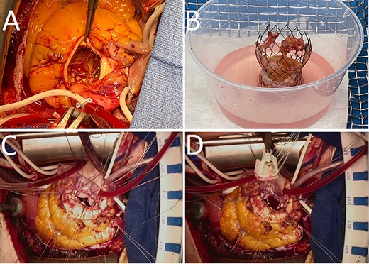 Gross images of the TAVI prosthesis showing vegetations in the stent ((A), (B)). The biological mitral (C) and aortic valve (D) prostheses were attached to a bovine pericardial patch, which was used to reconstruct the intervalvular fibrous body.