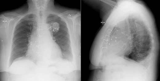 Postoperative chest X-ray showed ordinary findings with only a small amount of bilateral pleural effusion and adjacent pulmonary atelectasis.