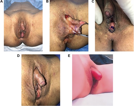 (A) Patient prior to surgery. Note hypertrophic clitoris and labia minora; (B) intraoperative photo of incision used for clitoral suspensory ligament release, and labia minora reduction prior to creation of micropenis; (C) diamond perineoplasty after creation of micropenis for narrowing of vaginal canal; (D) immediate postoperative photo after creation of micropenis, clitoral suspensory ligament release, labia minora reduction and perineoplasty; (E) 1-year postoperative and following use of clitoral suction device for enlargement of clitoris. Improvement in ASEX score and having penetrative vaginal intercourse.