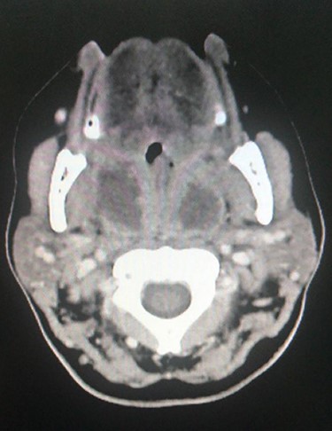 CT scan with IV contrast, axial view showing bilateral peritonsillar abscess with rim enhancement.
