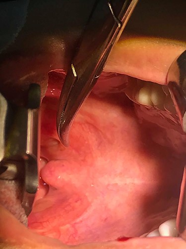 The 6 weeks post-acute interval tonsillectomy.