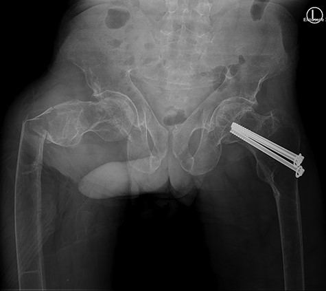 Anterior-posterior view: right-sided subtrochanteric femoral fracture, left-sided collum femoris screws.