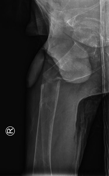 Medio-lateral view: subtrochanteric femoral fracture.