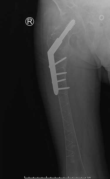 Post-operative anterior–posterior view: DHS osteosynthesis with intramedullary bone enhancement.