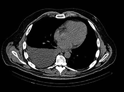 December 2019—CT chest: moderate to large right-sided pleural effusion.