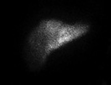 December 2019—IR procedure: NUC MED HEPATIC PUMP with SPECT/CT—appropriate perfusion of the liver after injection of radiotracer into the hepatic arterial infusion pump. No evidence of extrahepatic radiotracer collection identified.