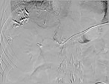 December 2019: procedure—IR venogram PROCEDURE: Hepatic Arterial Infusion Pump Evaluation, MAA Infusion—an angiogram was performed via the pump showing opacification of both right- and left-side hepatic arteries.