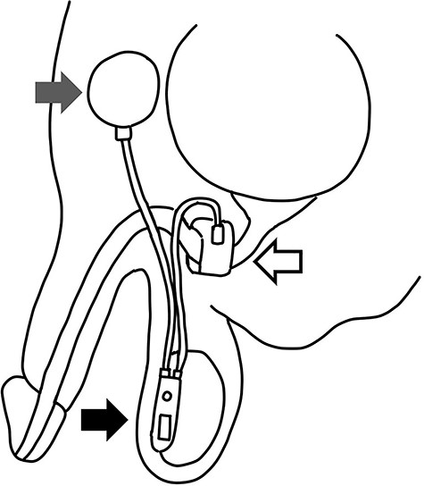 Schema of AUS: the AUS consists of three parts including an inflatable cuff (white arrow), a pressure regulating balloon (gray arrow) and the control pump with tube (black arrow).