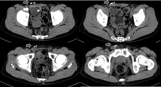 Abdominal CT in Case 1: CT showed that there was a balloon nearby the bladder and the tube went beside the rectus abdominis muscle from abdominal cavity; balloon, white arrow; tubes, gray arrows.