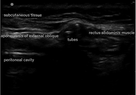 Abdominal US image in Case 1: US showed the tubes running under the aponeurosis of the external oblique that is the anterior wall of the inguinal canal.