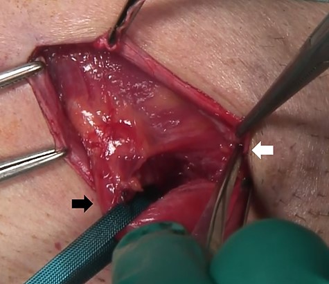 At the operation, the catheter of the AUS was observed in the inguinal canal; tubes, white arrow; spermatic cord, black arrow.