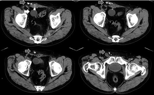 Abdominal CT in Case 2: the balloon was located near the bladder and the tube went through rectus abdominis muscle; balloon, white arrow; tubes, gray arrows.