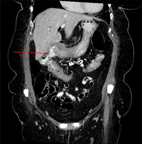 CT abdomen and pelvis demonstrating fistulous communication between distal stomach and transverse colon (red arrow) with pneumobilia.
