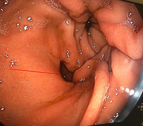 Pre-pyloric gastric fistula (red arrow) on upper GI endoscopy.