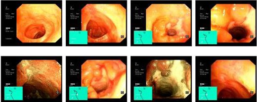 Lower GI endoscopy demonstrating ulceration, stenosis and stricturing of the transverse colon.