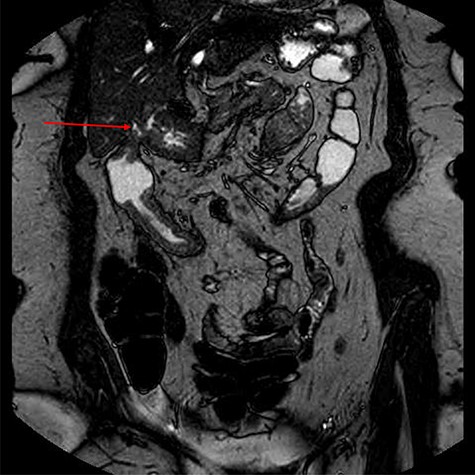 MRI demonstrating gastrocholecystocolic fistula (red arrow).