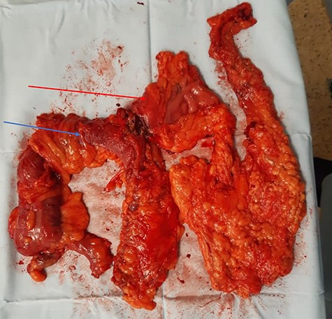 Specimen demonstrating en bloc distal gastrectomy (red arrow), cholecystectomy (shrunken and fibrosed to gastric antrum) and extended right hemicolectomy (blue arrow).