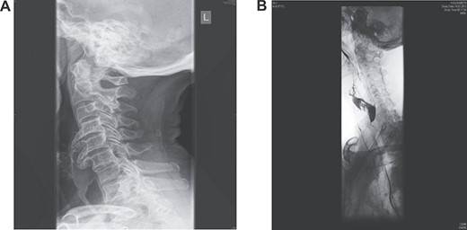 (A) Lateral X-ray reveals giant multilevel osteophytes at C4/5/6 compressing the oesophagus; (B) a gastrografin swallow showed that osteophytes were severely protruding impinging on the oesophagus with partial obstruction.