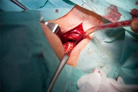 Intraoperative.