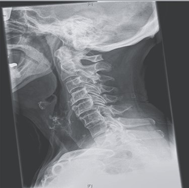 Post-operative lateral X-ray.