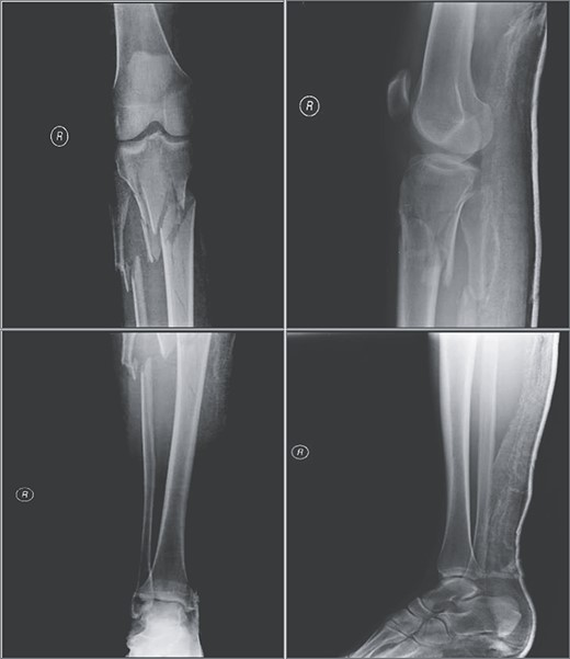Radiographic views demonstrating a complex proximal tibia fracture of the right leg.