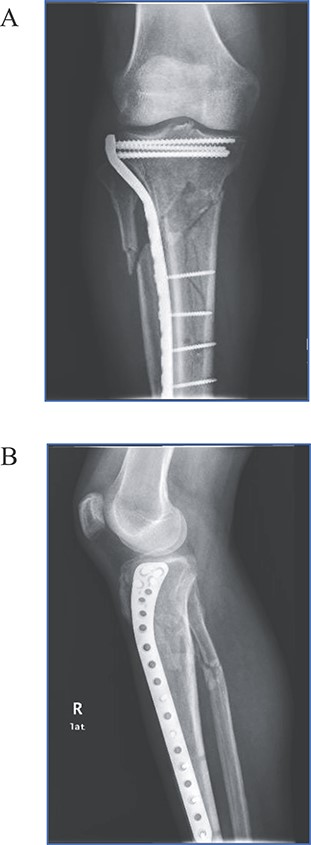 (A) Anteroposterior and (B) lateral views of the right tibia following minimally invasive percutaneous osteosynthesis. Images reveal proper alignment and fracture reduction.