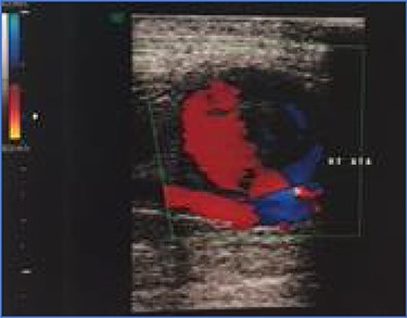 Noninvasive duplex ultrasound demonstrating a 3.4 x 2.7 cm pseudoaneurysm at the anterior tibialis artery.