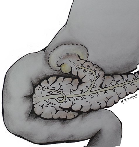 Schematic representation of the anatomic variant: duplicated head (the accessory parenchyma is a parenchymal band heading toward the pyloric region, containing an accessory duct connected with the pancreatic head on one side), and with a gastric duplication in the pyloric part of stomach on the other side.