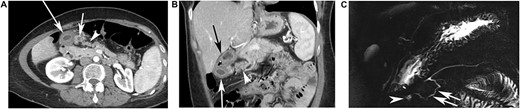 CT findings in a 49-year-old female patient who had 11 episodes of acute pancreatitis during 20 years. CECT performed 4 months after the occurrence of the last episode of pancreatitis showing an additional elongated pancreatic tissue, ahead of normal pancreas (arrowhead). (A) An additional elongated pancreatic tissue, ahead of normal pancreas (arrowhead) and two cysts are seen, under the pyloric part of stomach, very close to the heterotopic pancreas, the large cyst (long white arrow) was the gastric duplication, the small cyst (short white arrow) was a small abscess residue. (B) In this case, on this coronal view, the stomach was located over the gastric duplication (black arrow) and the duplicated pancreatic parenchyma (white arrow head), containing a duct, is clearly separated from the normal pancreatic parenchyma, associated with the gastric duplication cyst (long white arrow). (C) Magnetic Resonance Cholangio-Pancreatography (MRCP) points out the cystic lesion under the pyloric part of stomach (arrowhead), connected to a pancreatic accessory duct in a duplicated pancreatic head (white arrow), which is connected to the main pancreatic duct.