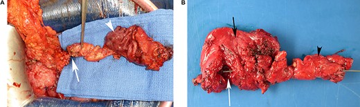 Gross examination of a surgical specimen. (A) Perioperative view of the complete resected tissue, showing the normal gastric mucosa (white arrowhead) and the duplicated head of pancreas (white arrow) before cutting the duct. (B) View of the complete specimen, including the gastric duplication (opened, white arrow), the gastric wall (side of the serosa, black arrow) and the duplicated head of pancreas (black arrowhead) containing a duplicated duct catheterized from the cut on pancreas to the gastric duplication with a metal probe.